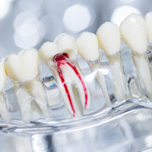 Root Canals in Denver